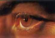 conjuntivitis
